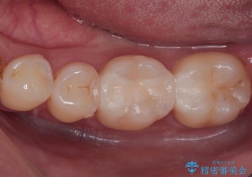 奥歯がしみる 保険の詰め物をセラミックインレーにの症例 治療後