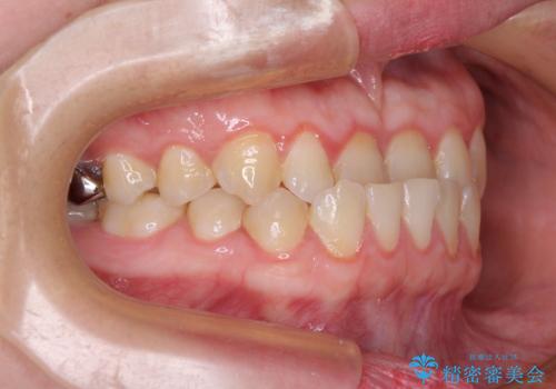 反対咬合を治したい ワイヤー装置で一気に咬み合わせを改善の治療前