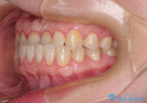 反対咬合を治したい ワイヤー装置で一気に咬み合わせを改善の治療前