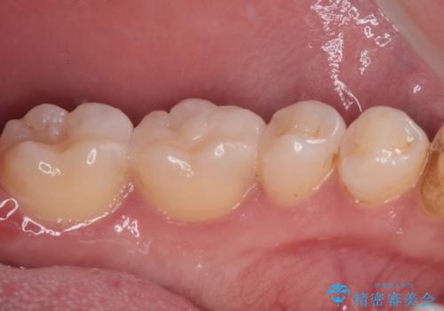 奥歯がしみる 保険の詰め物をセラミックインレーにの治療後