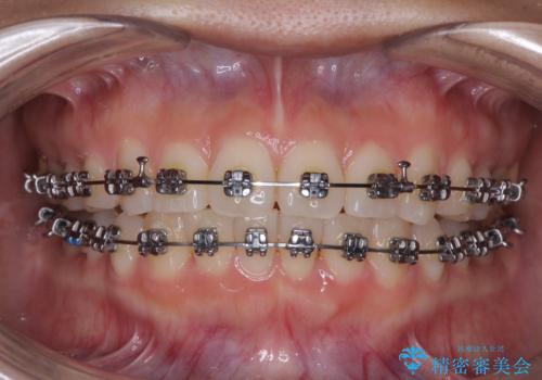 上下前歯のデコボコ ワイヤー装置で楽して改善の治療中