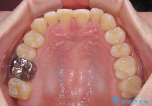 反対咬合を治したい ワイヤー装置で一気に咬み合わせを改善の治療前