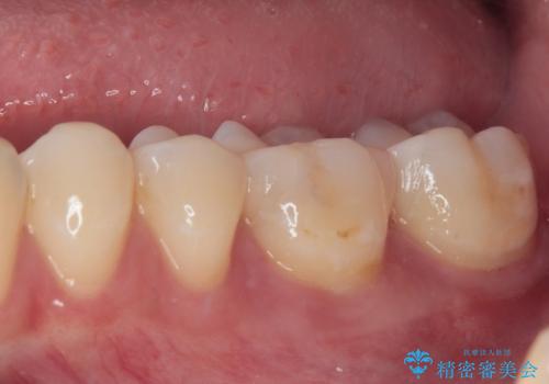 奥歯がしみる 保険の詰め物をセラミックインレーにの治療後