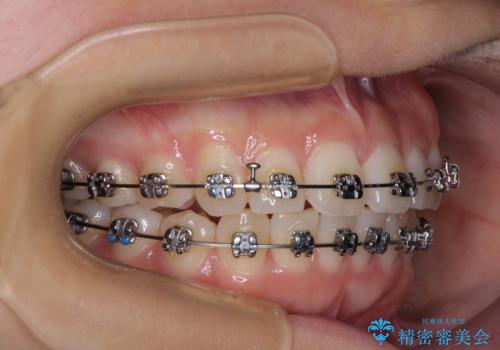 上下前歯のデコボコ ワイヤー装置で楽して改善の治療中