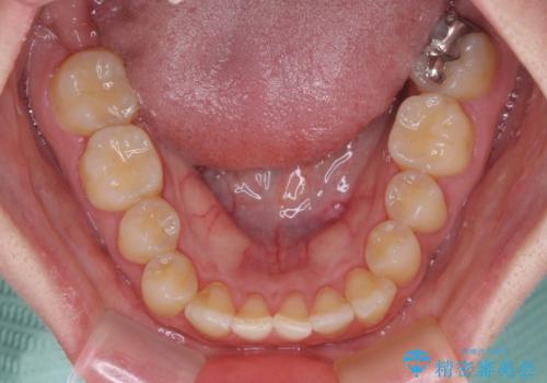 反対咬合を治したい ワイヤー装置で一気に咬み合わせを改善の治療前