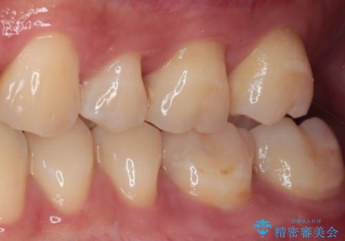 奥歯がしみる 保険の詰め物をセラミックインレーにの治療後
