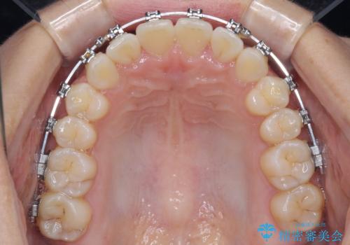 上下前歯のデコボコ ワイヤー装置で楽して改善の治療中