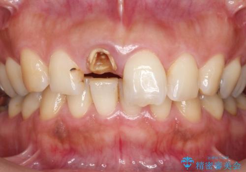 折れてしまった前歯   オールセラミックによる審美改善