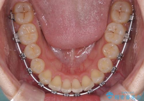 上下前歯のデコボコ ワイヤー装置で楽して改善の治療中