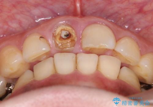 折れてしまった前歯   オールセラミックによる審美改善の治療前