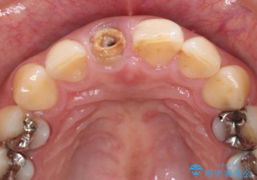 折れてしまった前歯   オールセラミックによる審美改善の治療前