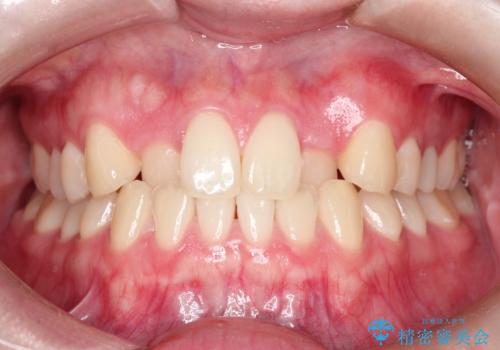 インビザラインとワイヤー矯正の併用で綺麗な歯並びに!の症例 治療前