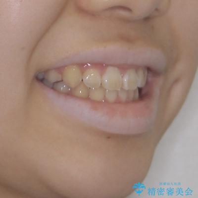 舌突出癖で出っ歯と開咬に 舌のトレーニングを行いながら抜歯矯正 の治療後(顔貌)