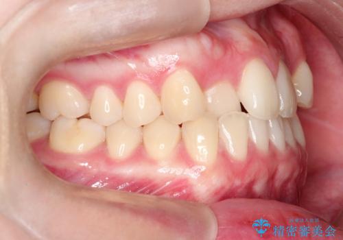 インビザラインとワイヤー矯正の併用で綺麗な歯並びに!の治療前