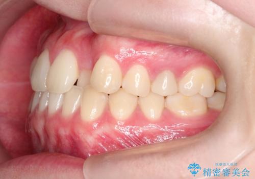 インビザラインとワイヤー矯正の併用で綺麗な歯並びに!の治療前