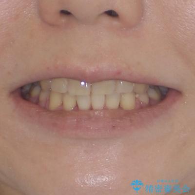 治療途中で帰国 装置をつけた状態を継続して矯正治療の治療後(顔貌)