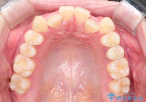 インビザラインとワイヤー矯正の併用で綺麗な歯並びに!の治療前