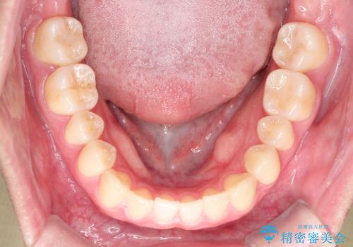 インビザラインとワイヤー矯正の併用で綺麗な歯並びに!の治療前