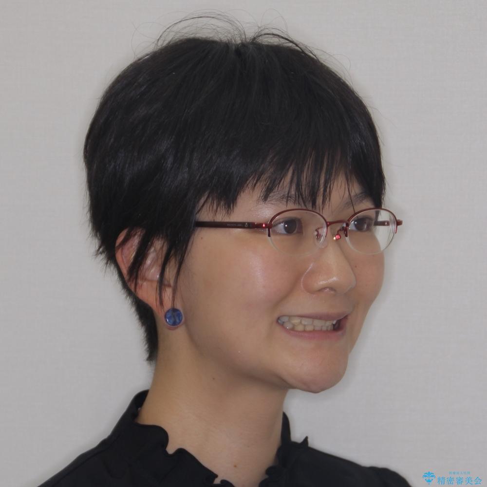 【モニター】出っ歯と八重歯 抜歯矯正でスッキリとした口元にの治療後(顔貌)