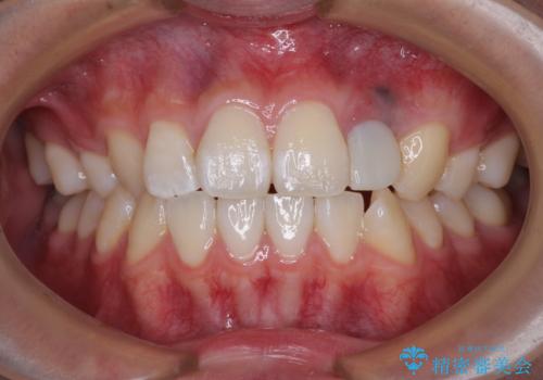 抜歯と言われた前歯 牽引してセラミッククラウンで保存するの治療中