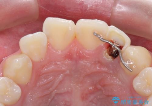 抜歯と言われた前歯 牽引してセラミッククラウンで保存するの治療中