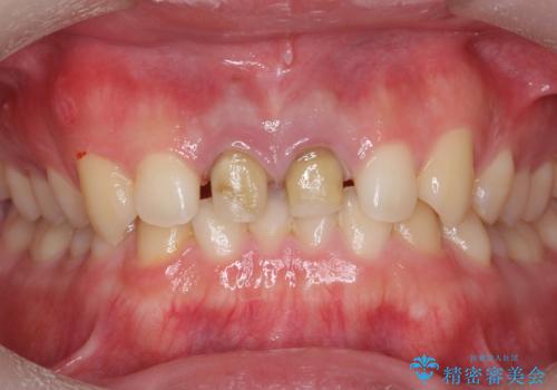 前歯の変色 神経のない歯の再治療の治療中