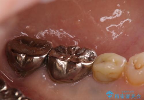 毎食後物がつまる! インプラント治療の症例 治療前