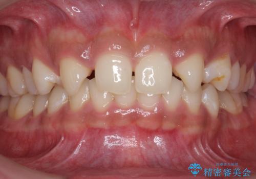 前歯のすきま　生まれつき歯が少ないのを治療の治療前