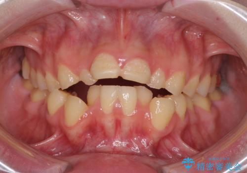 酸蝕歯でボロボロの歯の審美歯科治療　矯正治療も併用して、美しい口元への症例 治療前