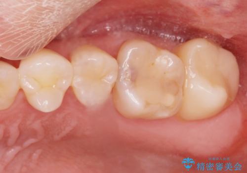 [歯と歯の間の虫歯] ジルコニアクラウンの症例 治療前