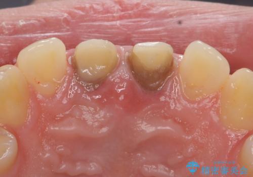 前歯の変色 神経のない歯の再治療の治療中