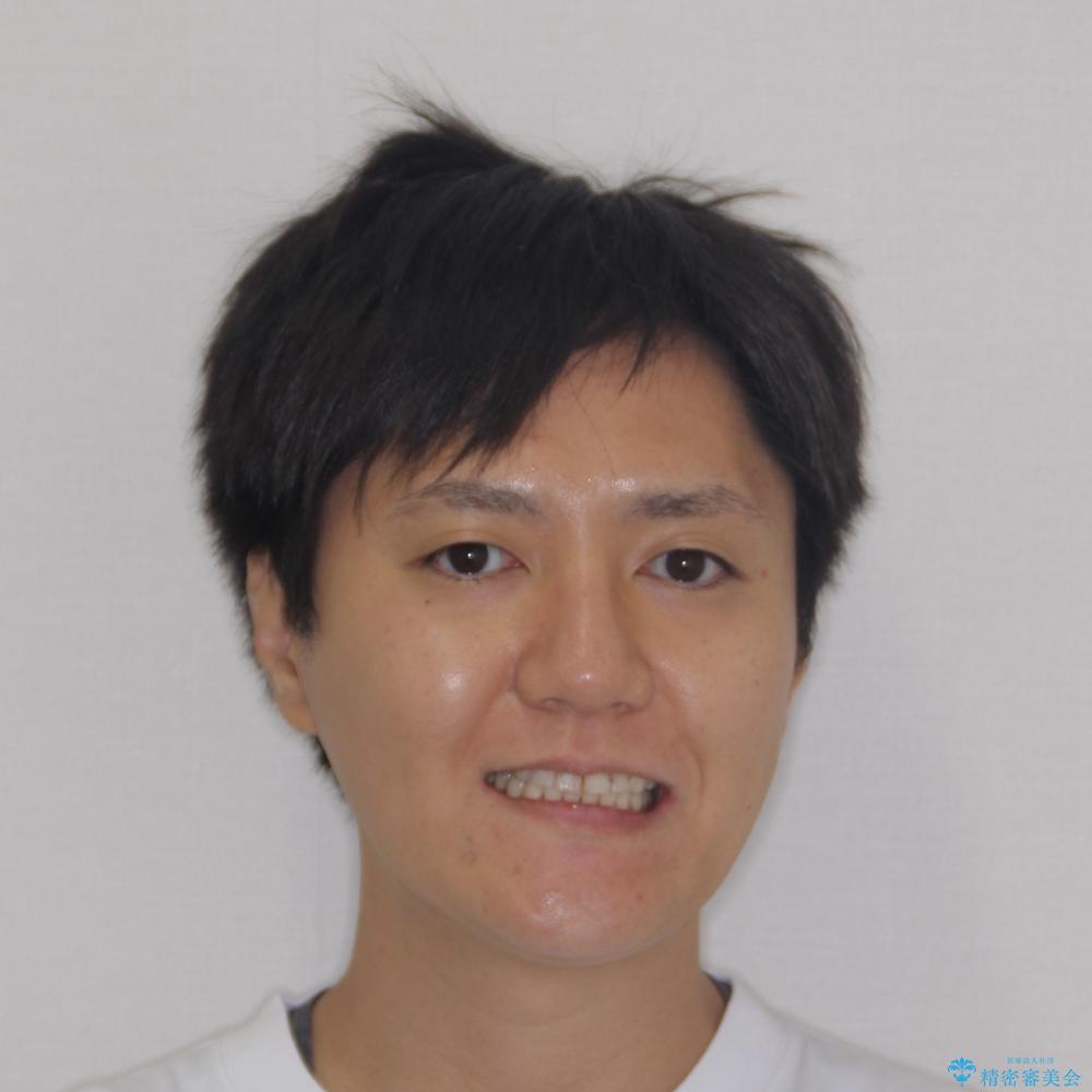 【モニター】動きにくい歯と乱れた咬合平面 アンカースクリューで咬合改善の治療後(顔貌)