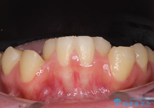 酸蝕歯でボロボロの歯の審美歯科治療　矯正治療も併用して、美しい口元への治療前