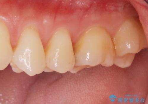 [歯と歯の間の虫歯] ジルコニアクラウンの治療前
