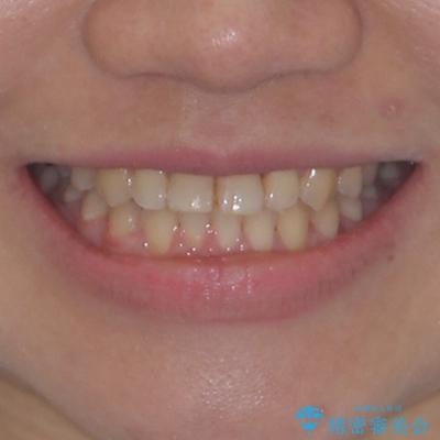 反対咬合を治したい ワイヤー装置で一気に咬み合わせを改善の治療後(顔貌)