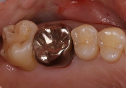 歯がしみる　セラミックインレーで改善の症例 治療前