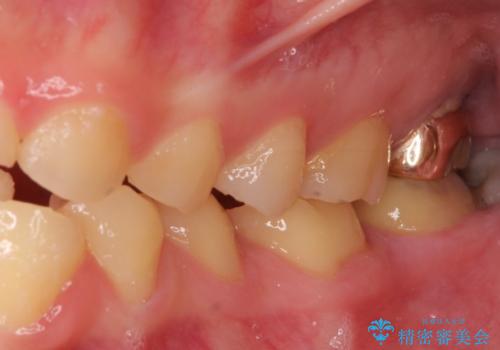 酸蝕歯でボロボロの歯の審美歯科治療　矯正治療も併用して、美しい口元への治療前