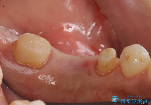 奥歯の高さがない 20代で入れ歯もインプラントも難しい ブリッジで歯を残す治療の治療中