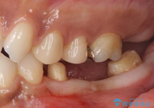 奥歯の高さがない　20代で入れ歯もインプラントも難しい　ブリッジで歯を残す治療の治療中