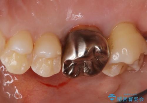 歯がしみる セラミックインレーで改善の治療前