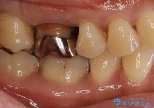 歯がしみる セラミックインレーで改善の治療前