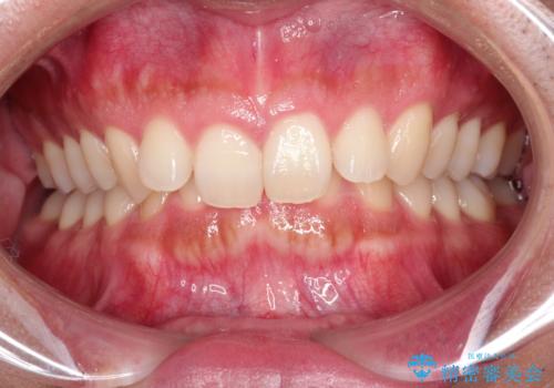 【インビザライン】ディープバイトを治したいの症例 治療前