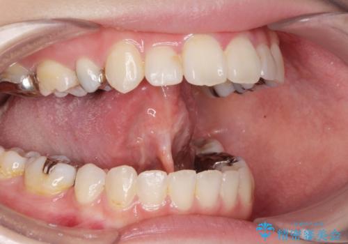 舌が動かしにくいから舌小帯を切りたいの治療前