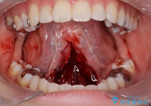 舌が動かしにくいから舌小帯を切りたいの治療中