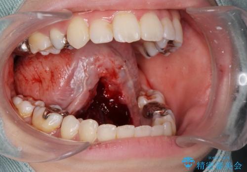 舌が動かしにくいから舌小帯を切りたいの治療中