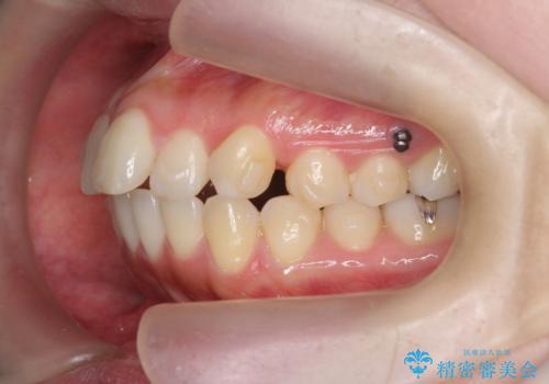 不安定な噛み合わせを改善 マウスピース矯正治療の治療中