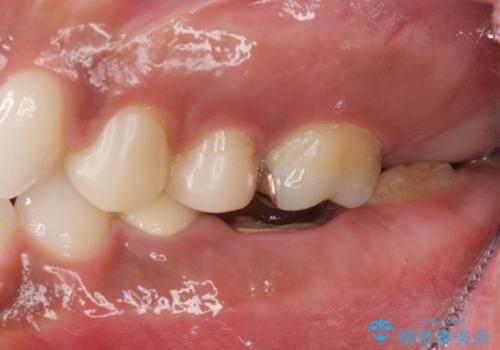 奥歯の高さがない　20代で入れ歯もインプラントも難しい　ブリッジで歯を残す治療の治療前