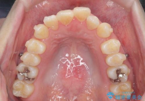 不安定な噛み合わせを改善 マウスピース矯正治療の治療中