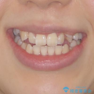 八重歯と開咬の抜歯矯正　ワイヤー装置を併用したインビザライン矯正治療の治療前（顔貌）