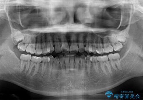 咬み合わせの乱れを改善 ワイヤー装置で楽々矯正治療の治療前
